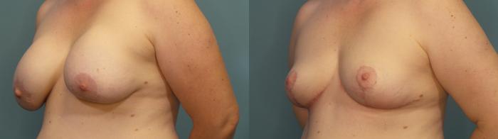 Before & After Breast Revision Case 345 Left Oblique View in Portland, OR