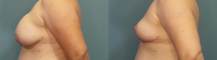 Before & After Breast Revision Case 345 Left Side View in Portland, OR