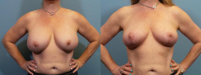 Before & After Breast Revision Case 368 Front View in Portland, OR