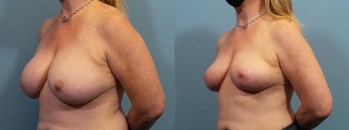 Before & After Breast Revision Case 368 Left Oblique View in Portland, OR