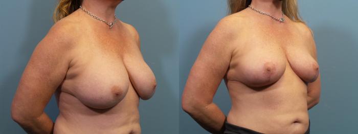 Before & After Breast Revision Case 368 Right Oblique View in Portland, OR