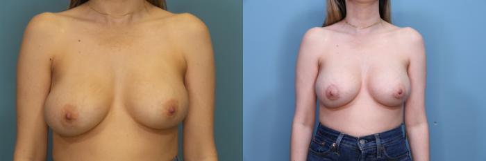 Before & After Breast Lift with Implants Case 370 Front View in Portland, OR