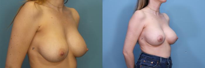 Before & After Breast Lift with Implants Case 370 Right Oblique View in Portland, OR