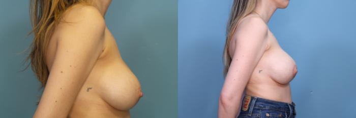 Before & After Breast Lift with Implants Case 370 Right Side View in Portland, OR