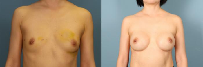 Before & After Breast Revision Case 385 Front View in Portland, OR