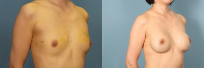Before & After Breast Revision Case 385 Right Oblique View in Portland, OR