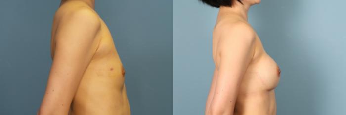Before & After Breast Revision Case 385 Right Side View in Portland, OR