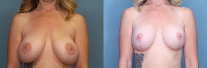 Before & After Breast Revision Case 386 Front View in Portland, OR