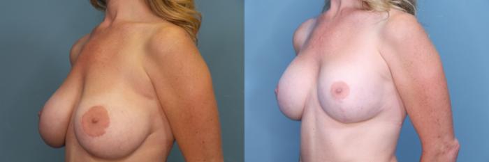 Before & After Breast Revision Case 386 Left Oblique View in Portland, OR