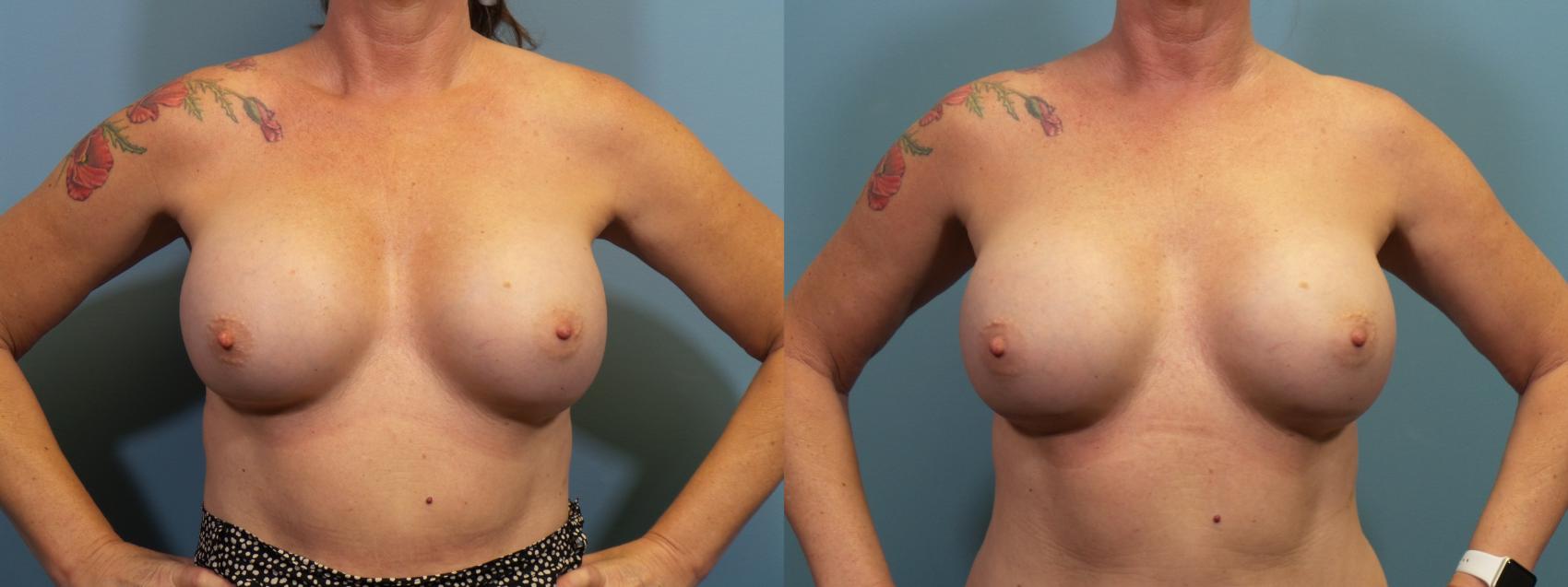 Before & After Breast Revision Case 408 Front View in Portland, OR