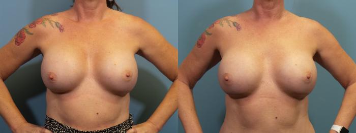 Before & After Breast Revision Case 408 Front View in Portland, OR