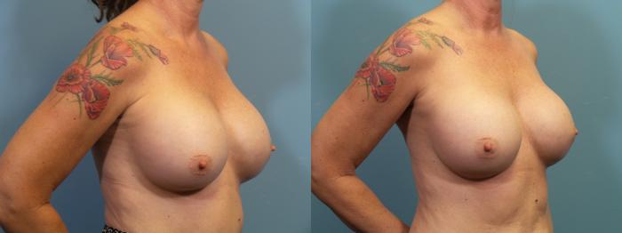 Before & After Breast Revision Case 408 Right Oblique View in Portland, OR