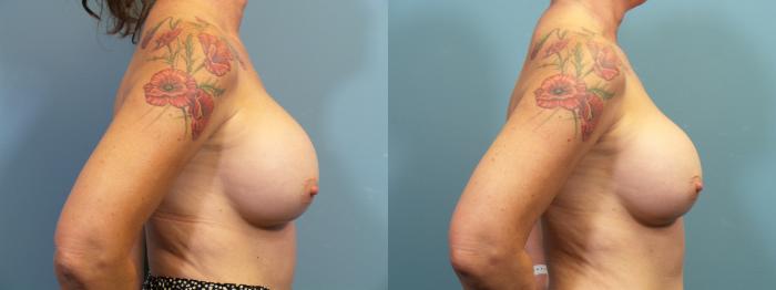 Before & After Breast Revision Case 408 Right Side View in Portland, OR