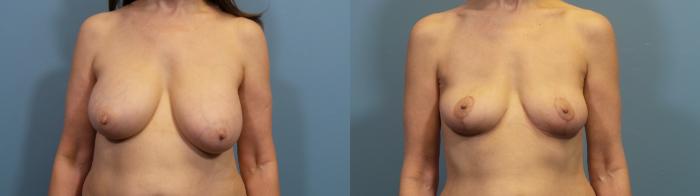 Before & After Breast Revision Case 419 Front View in Portland, OR