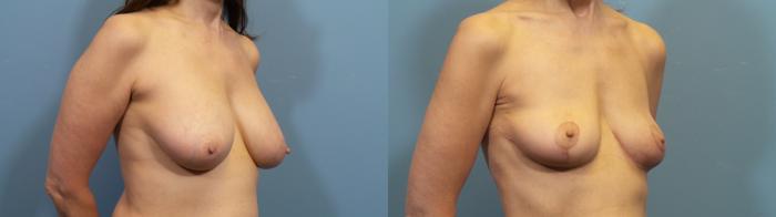 Before & After Breast Revision Case 419 Right Oblique View in Portland, OR