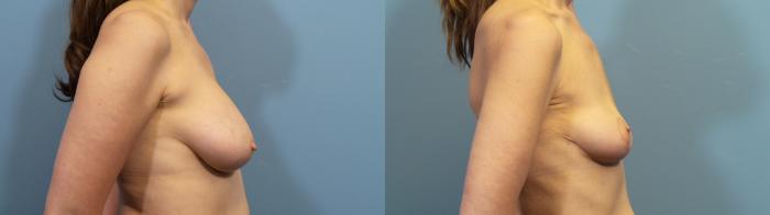 Before & After Breast Revision Case 419 Right Side View in Portland, OR