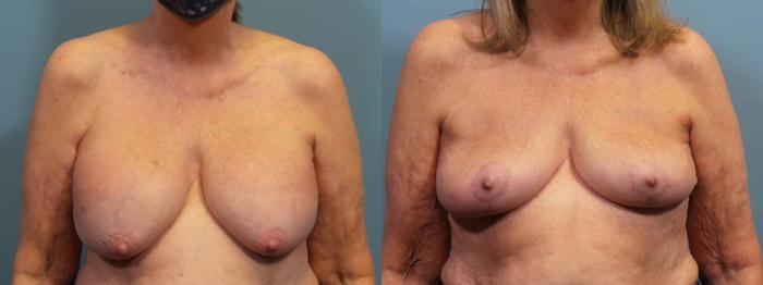 Before & After Breast Revision Case 428 Front View in Portland, OR
