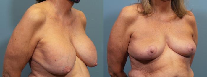 Before & After Breast Lift Case 428 Right Oblique View in Portland, OR