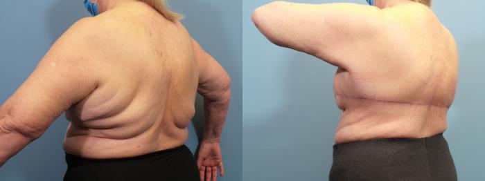 Before & After Massive Weight Loss/Body Lift Case 433 Back Oblique  View in Portland, OR