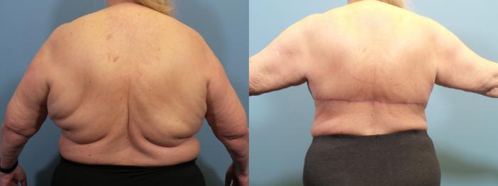 Before & After Massive Weight Loss/Body Lift Case 433 Back View in Portland, OR