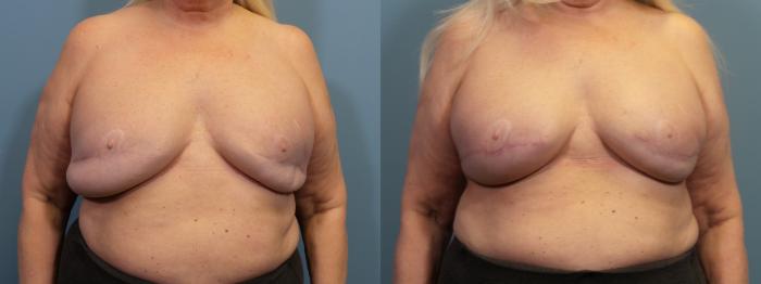 Before & After Breast Revision Case 433 Front View in Portland, OR