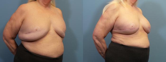 Before & After Breast Revision Case 433 Right Oblique View in Portland, OR