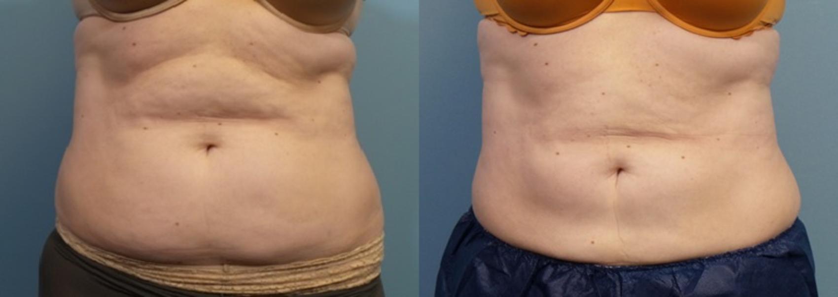 Before & After CoolSculpting Case 236 View #1 View in Portland, OR