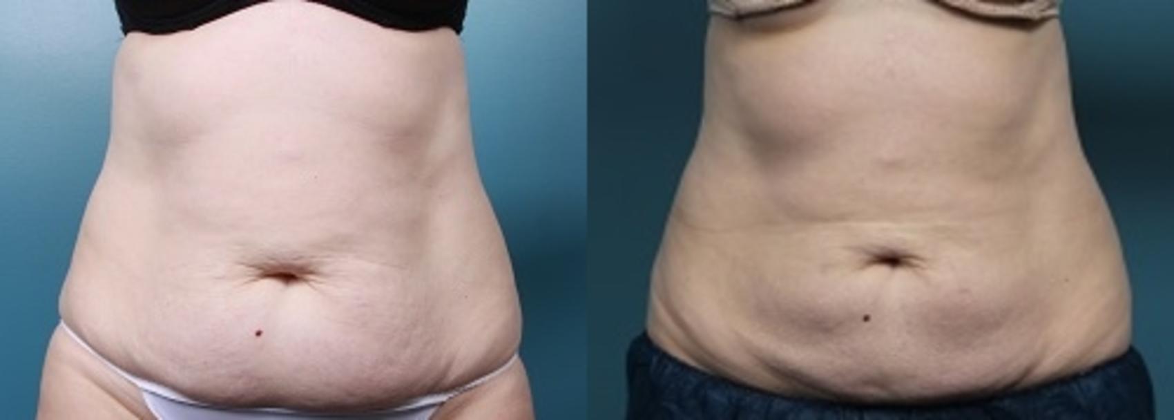 Before & After CoolSculpting Case 49 View #1 View in Portland, OR