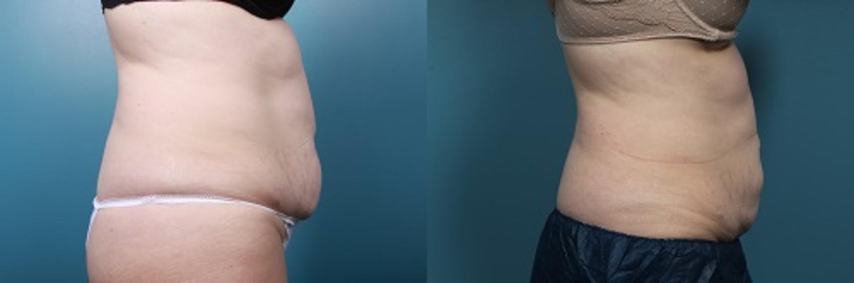 Before & After CoolSculpting Case 49 View #2 View in Portland, OR