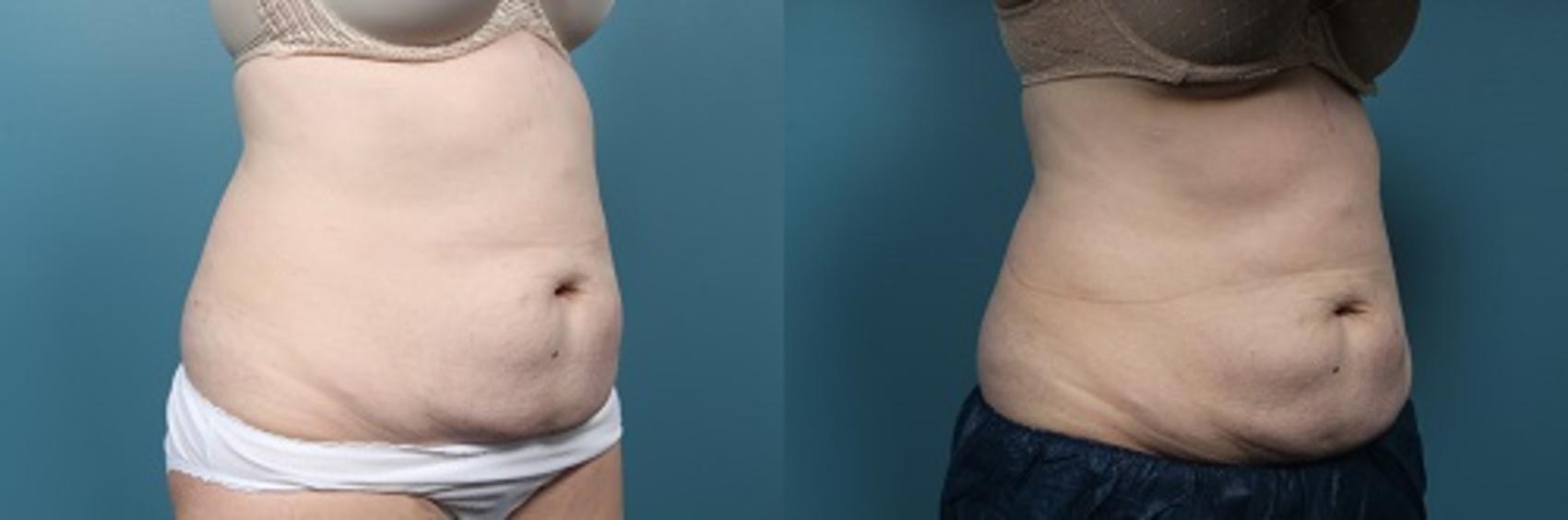 Before & After CoolSculpting Case 49 View #3 View in Portland, OR