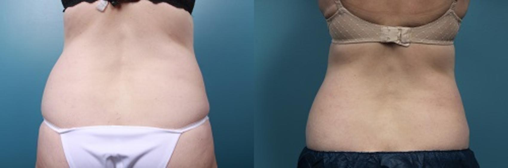 Before & After CoolSculpting Case 49 View #4 View in Portland, OR