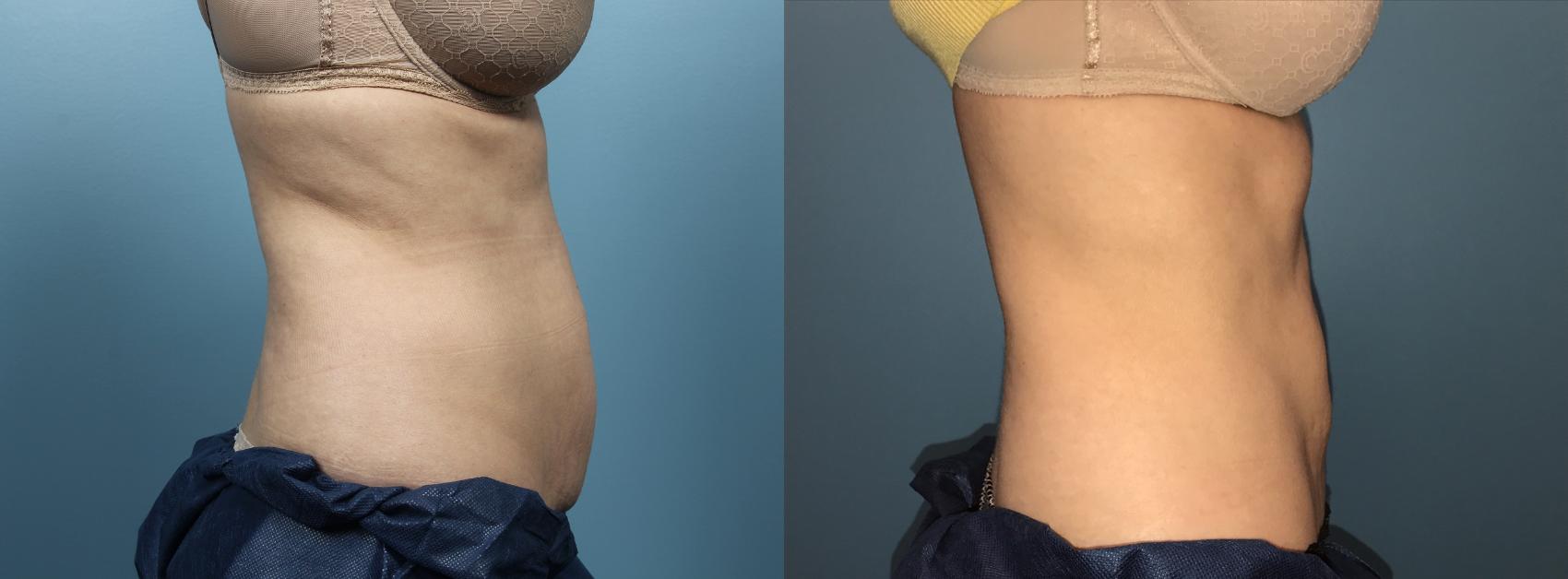 Before & After CoolSculpting Case 82 View #1 View in Portland, OR