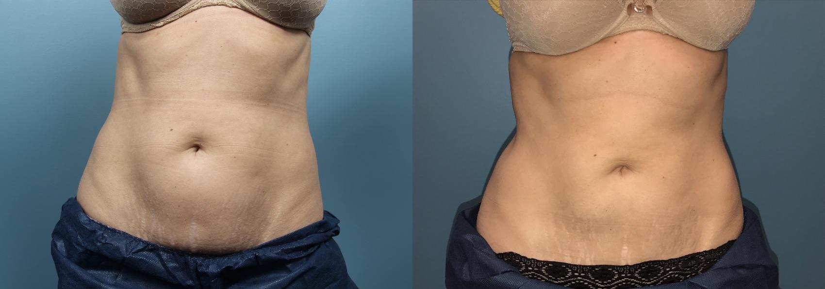 Before & After CoolSculpting Case 82 View #2 View in Portland, OR