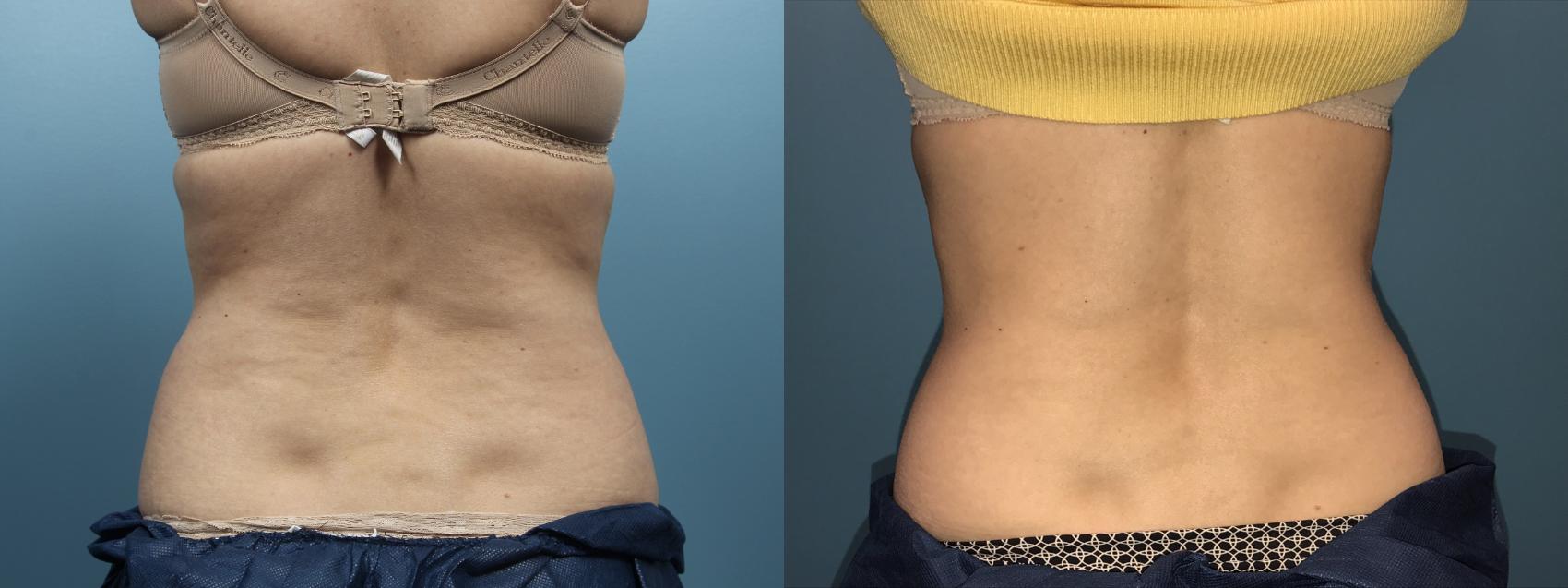 Before & After CoolSculpting Case 82 View #3 View in Portland, OR