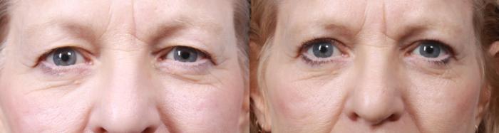 Before & After Eyelid Surgery (Blepharoplasty) Case 31 View #1 View in Portland, OR