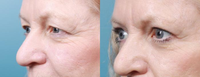 Before & After Eyelid Surgery (Blepharoplasty) Case 31 View #2 View in Portland, OR