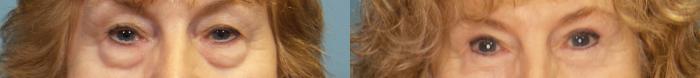 Before & After Eyelid Surgery (Blepharoplasty) Case 399 Front View in Portland, OR