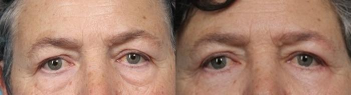 Before & After Eyelid Surgery (Blepharoplasty) Case 51 View #1 View in Portland, OR