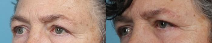 Before & After Eyelid Surgery (Blepharoplasty) Case 51 View #2 View in Portland, OR