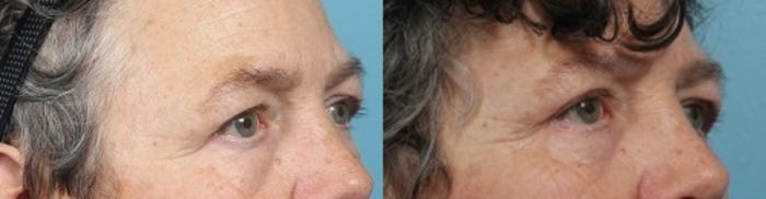 Before & After Eyelid Surgery (Blepharoplasty) Case 51 View #3 View in Portland, OR