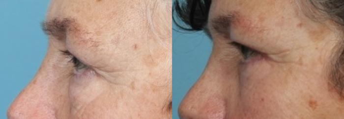 Before & After Eyelid Surgery (Blepharoplasty) Case 51 View #4 View in Portland, OR
