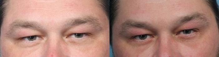 Before & After Eyelid Surgery (Blepharoplasty) Case 52 View #1 View in Portland, OR