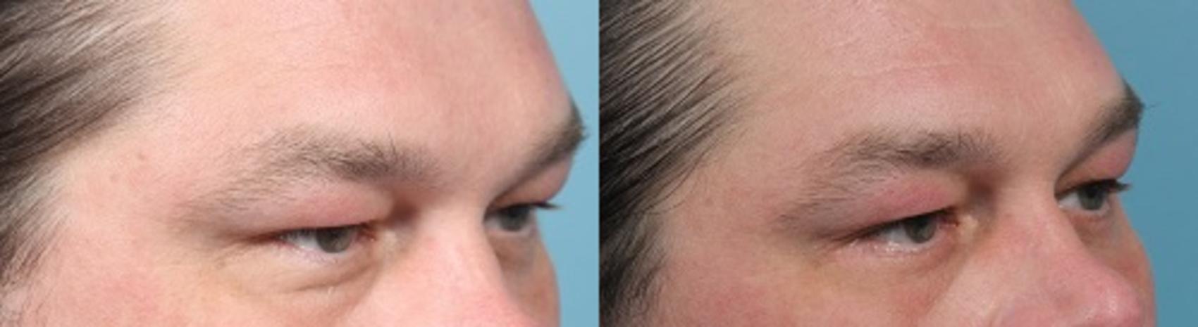 Before & After Eyelid Surgery (Blepharoplasty) Case 52 View #2 View in Portland, OR
