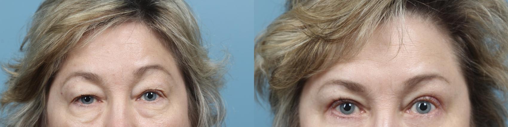 Before & After Eyelid Surgery (Blepharoplasty) Case 78 View #1 View in Portland, OR