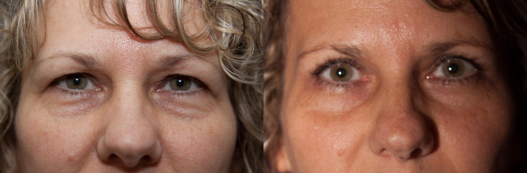 Before & After Eyelid Surgery (Blepharoplasty) Case 8 View #1 View in Portland, OR