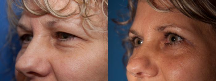 Before & After Eyelid Surgery (Blepharoplasty) Case 8 View #2 View in Portland, OR