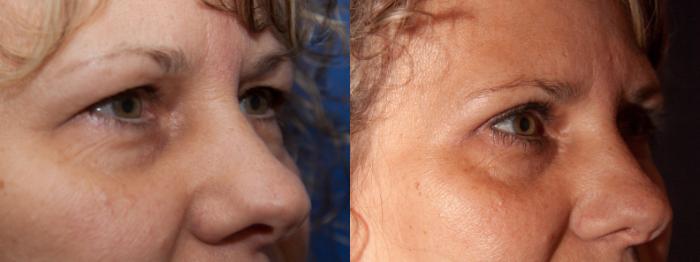 Before & After Eyelid Surgery (Blepharoplasty) Case 8 View #3 View in Portland, OR