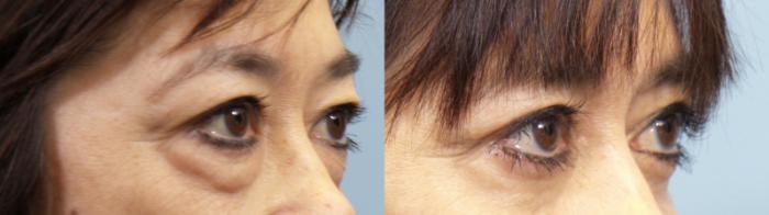 Before & After Eyelid Surgery (Blepharoplasty) Case 95 View #2 View in Portland, OR