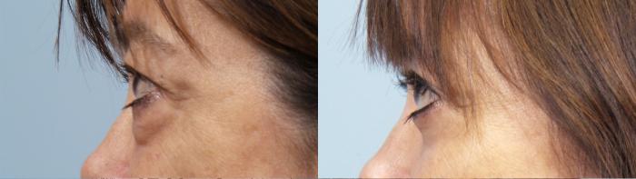 Before & After Eyelid Surgery (Blepharoplasty) Case 95 View #3 View in Portland, OR