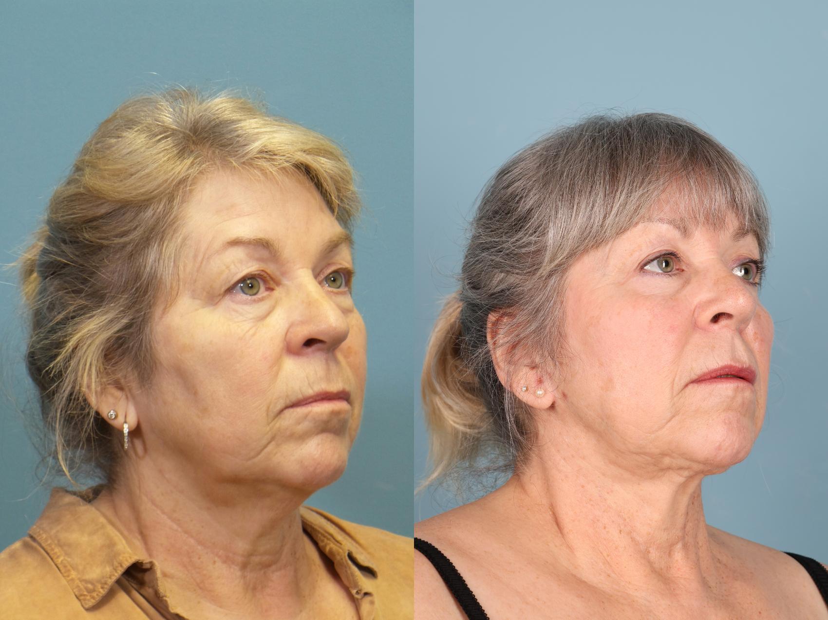 Before & After Eyelid Surgery (Blepharoplasty) Case 388 Right Oblique View in Portland, OR